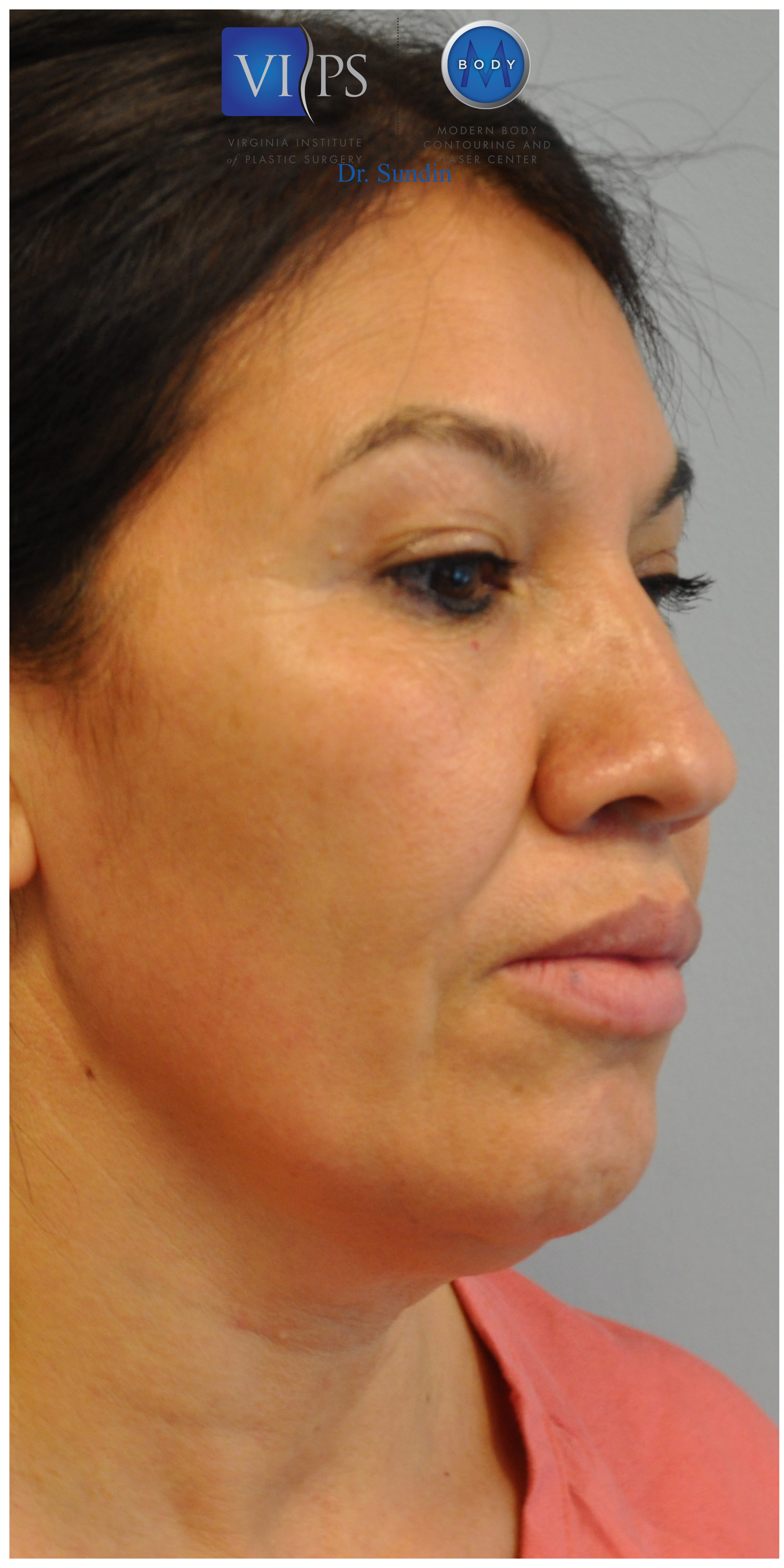 Facelift Before and After | Little Lipo