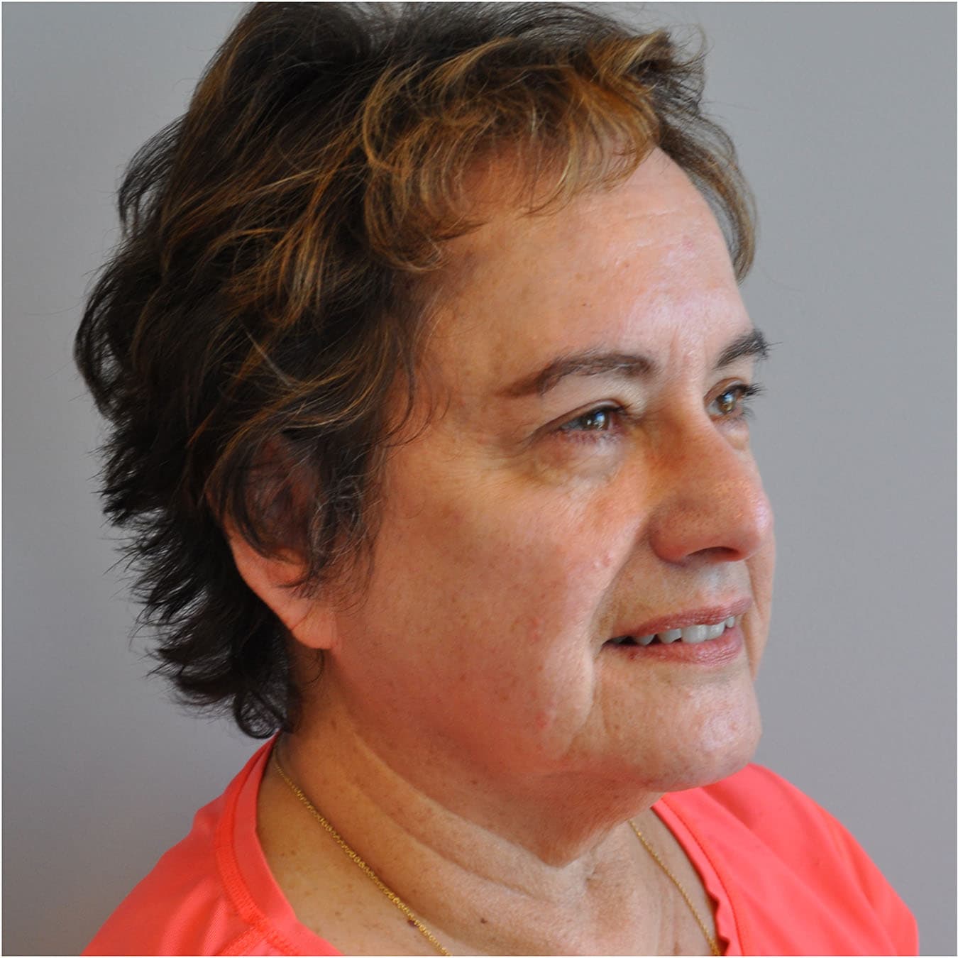 Facelift Before and After | Little Lipo