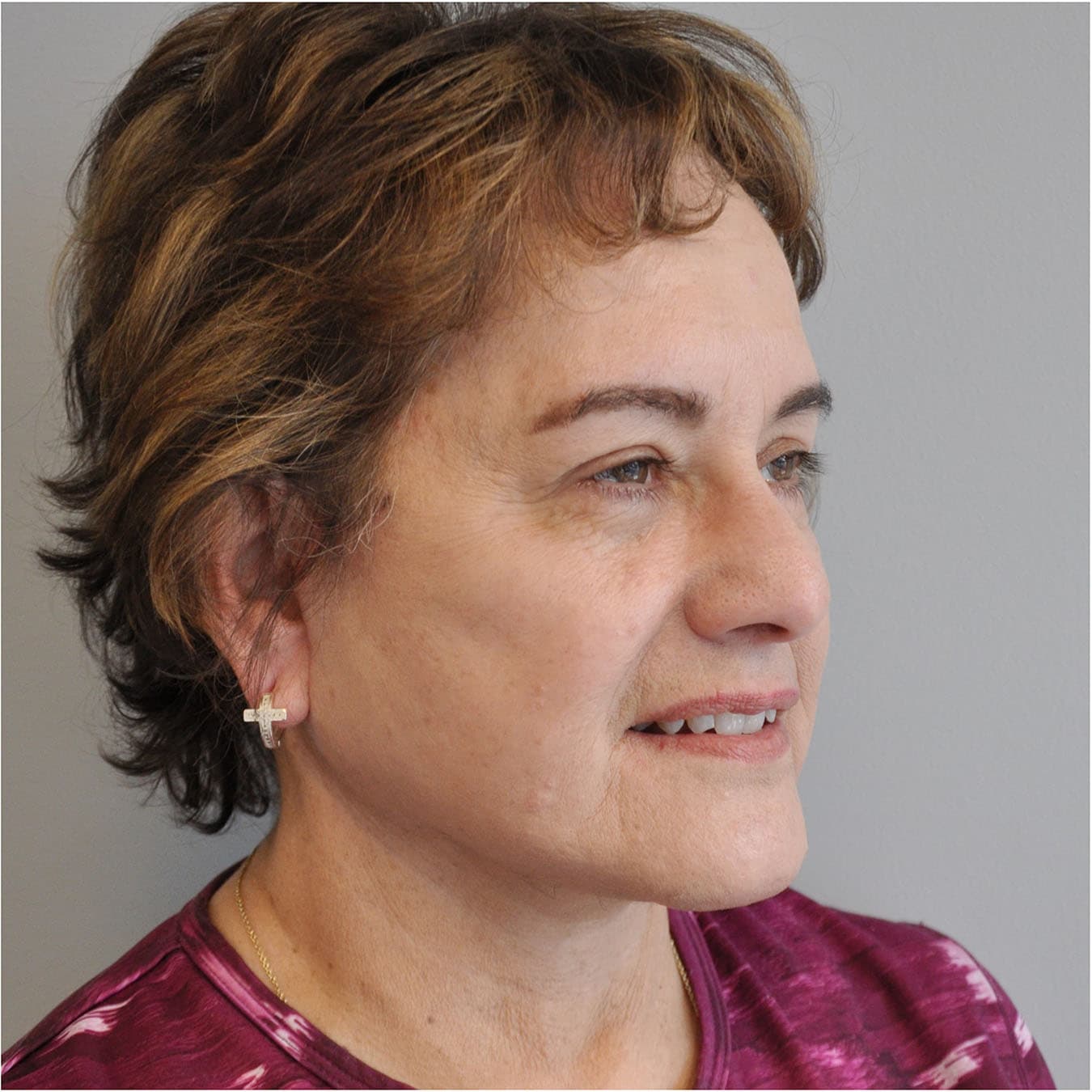 Facelift Before and After | Little Lipo