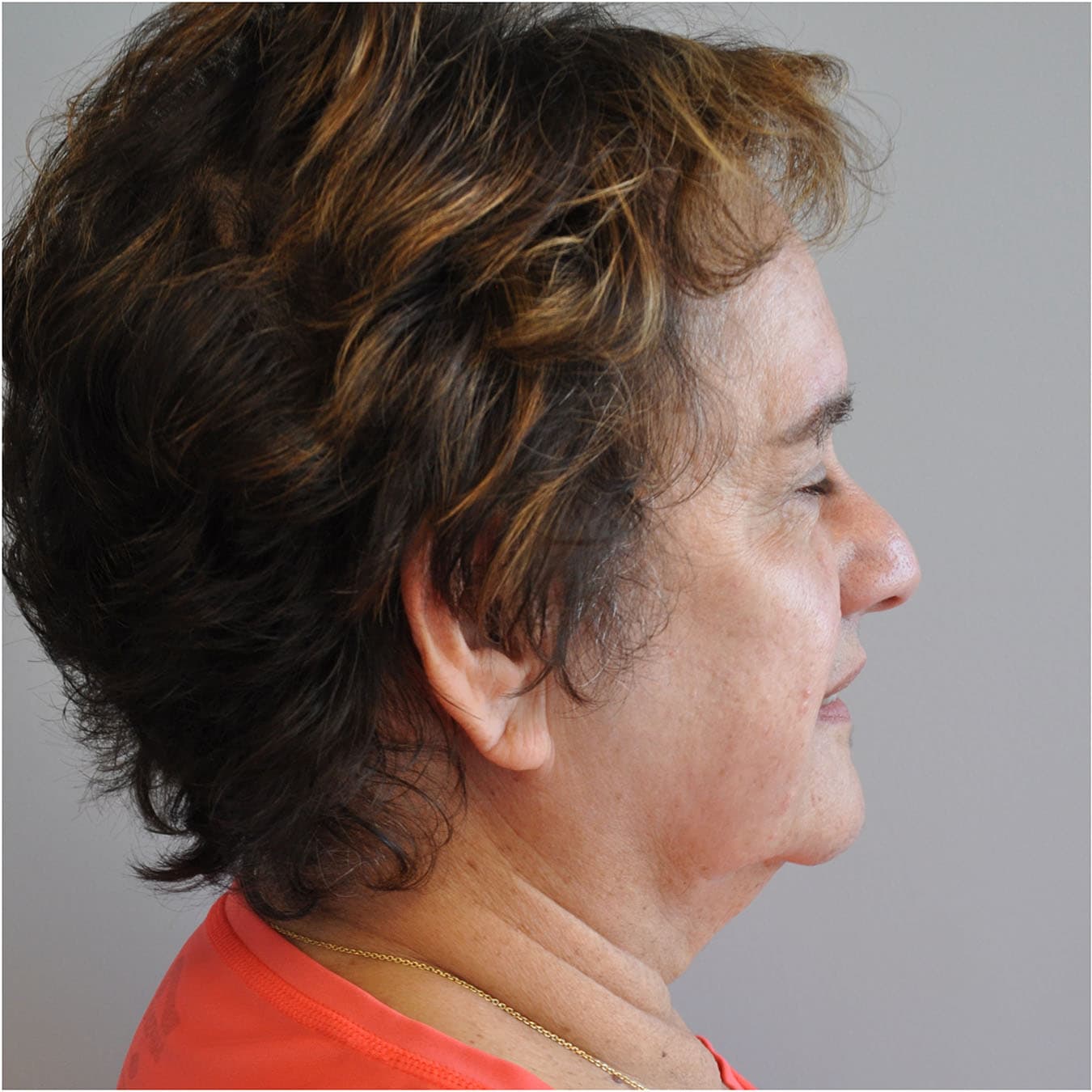 Facelift Before and After | Little Lipo