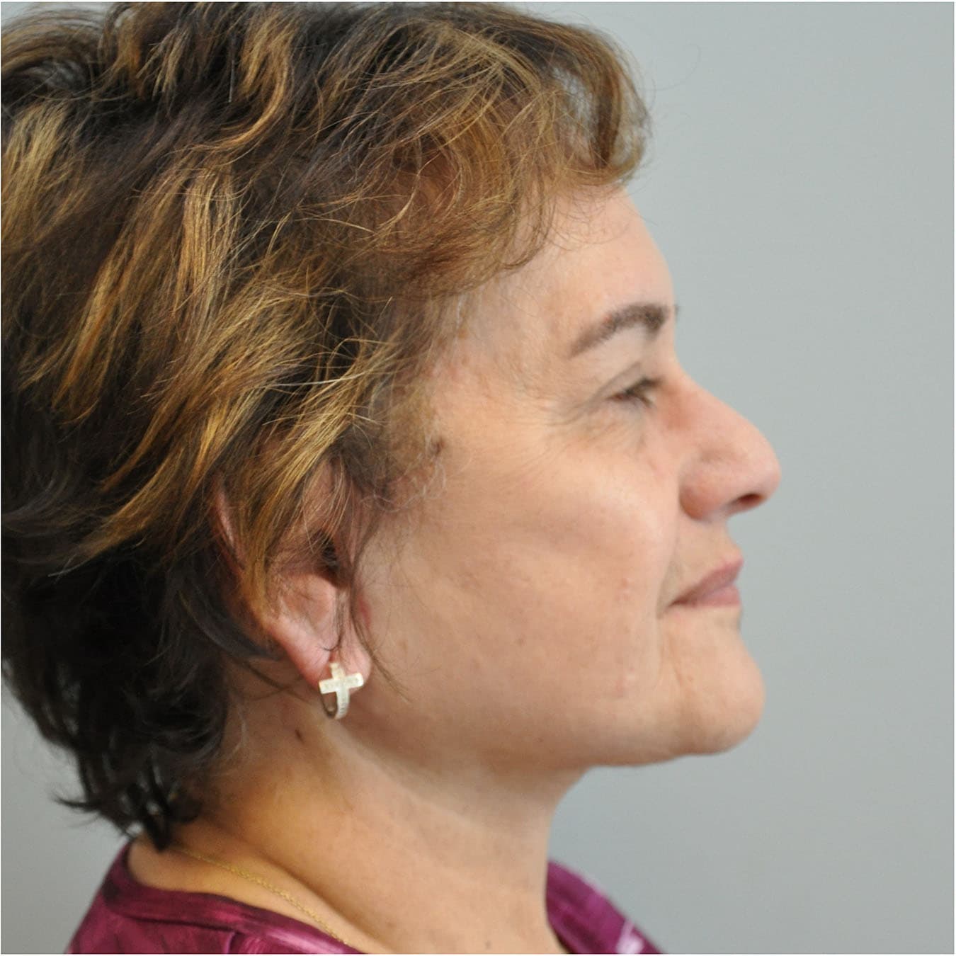 Facelift Before and After | Little Lipo