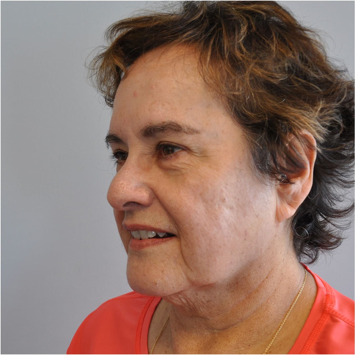 Facelift Before and After | Little Lipo