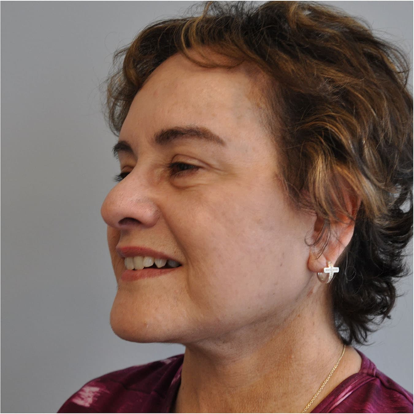 Facelift Before and After | Little Lipo