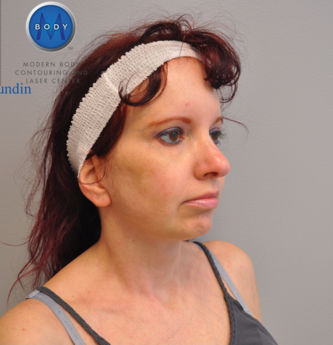 Facelift Before and After | Little Lipo