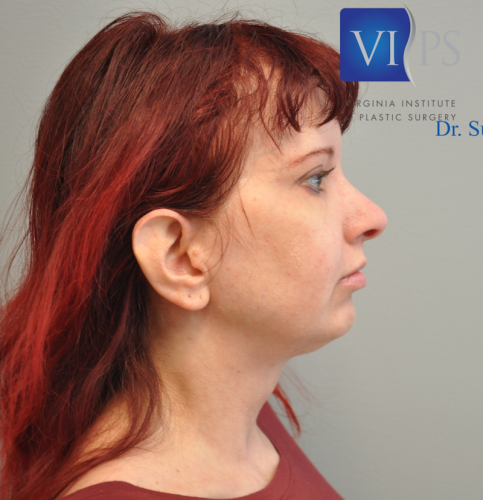 Facelift Before and After | Little Lipo