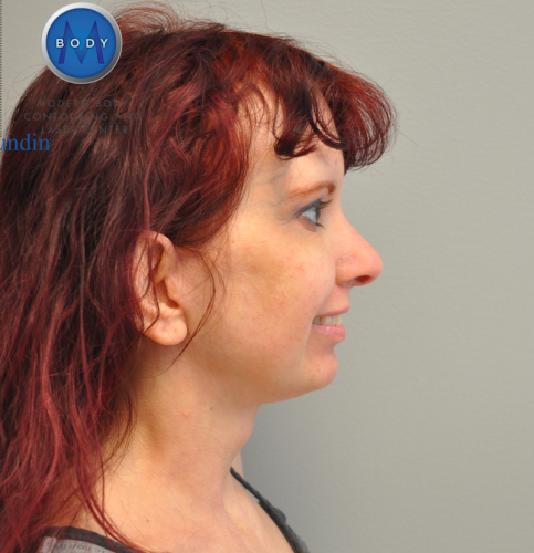 Facelift Before and After | Little Lipo