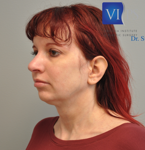 Facelift Before and After | Little Lipo