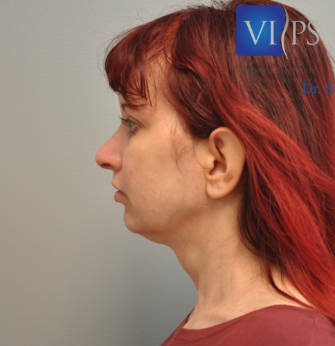 Facelift Before and After | Little Lipo