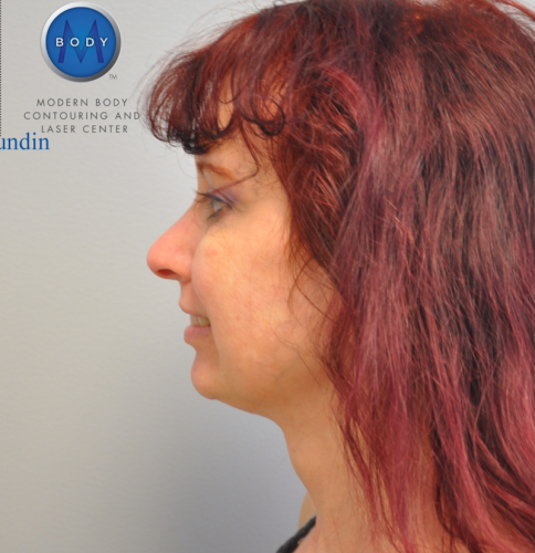 Facelift Before and After | Little Lipo