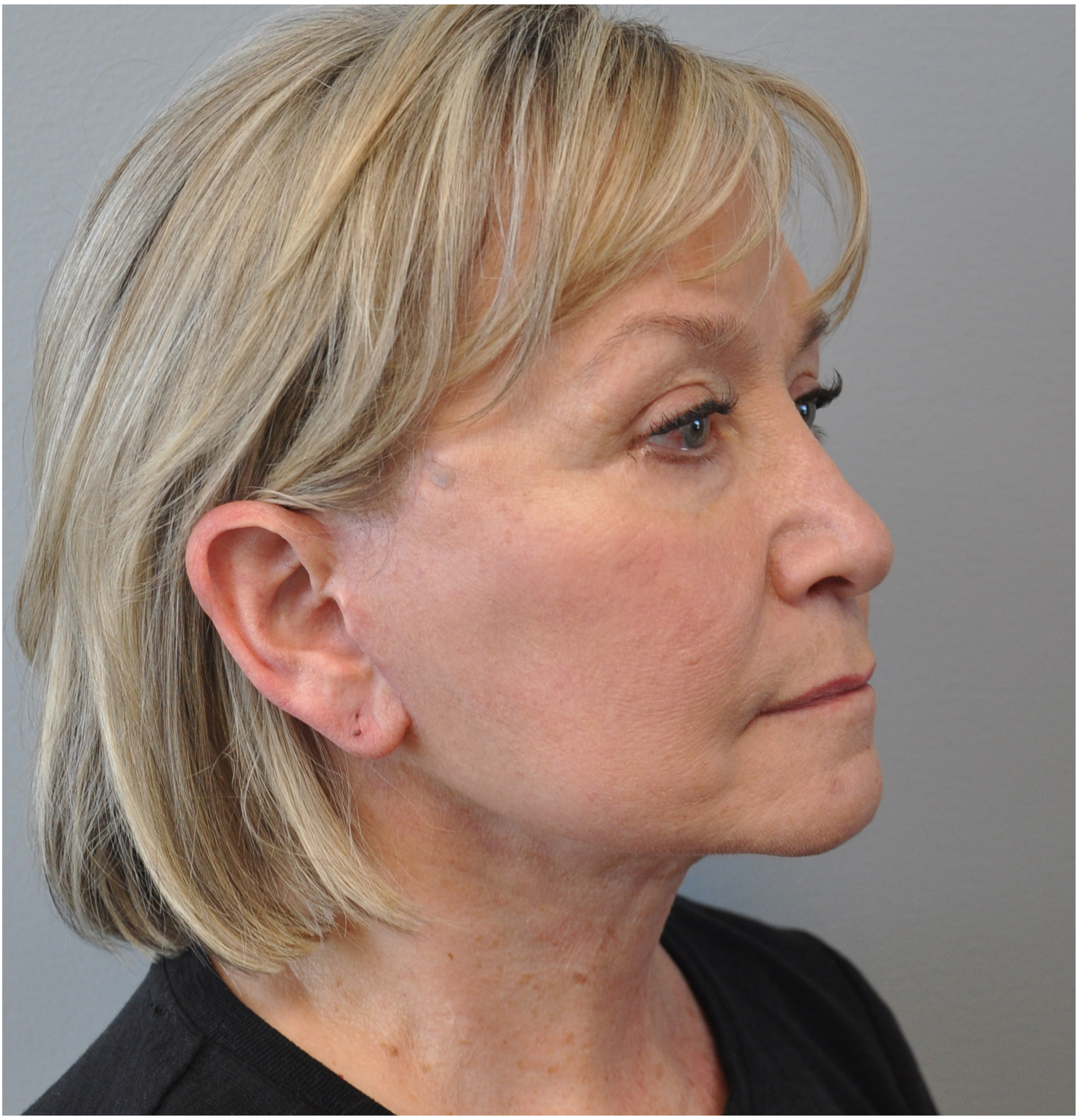 Facelift Before and After | Little Lipo