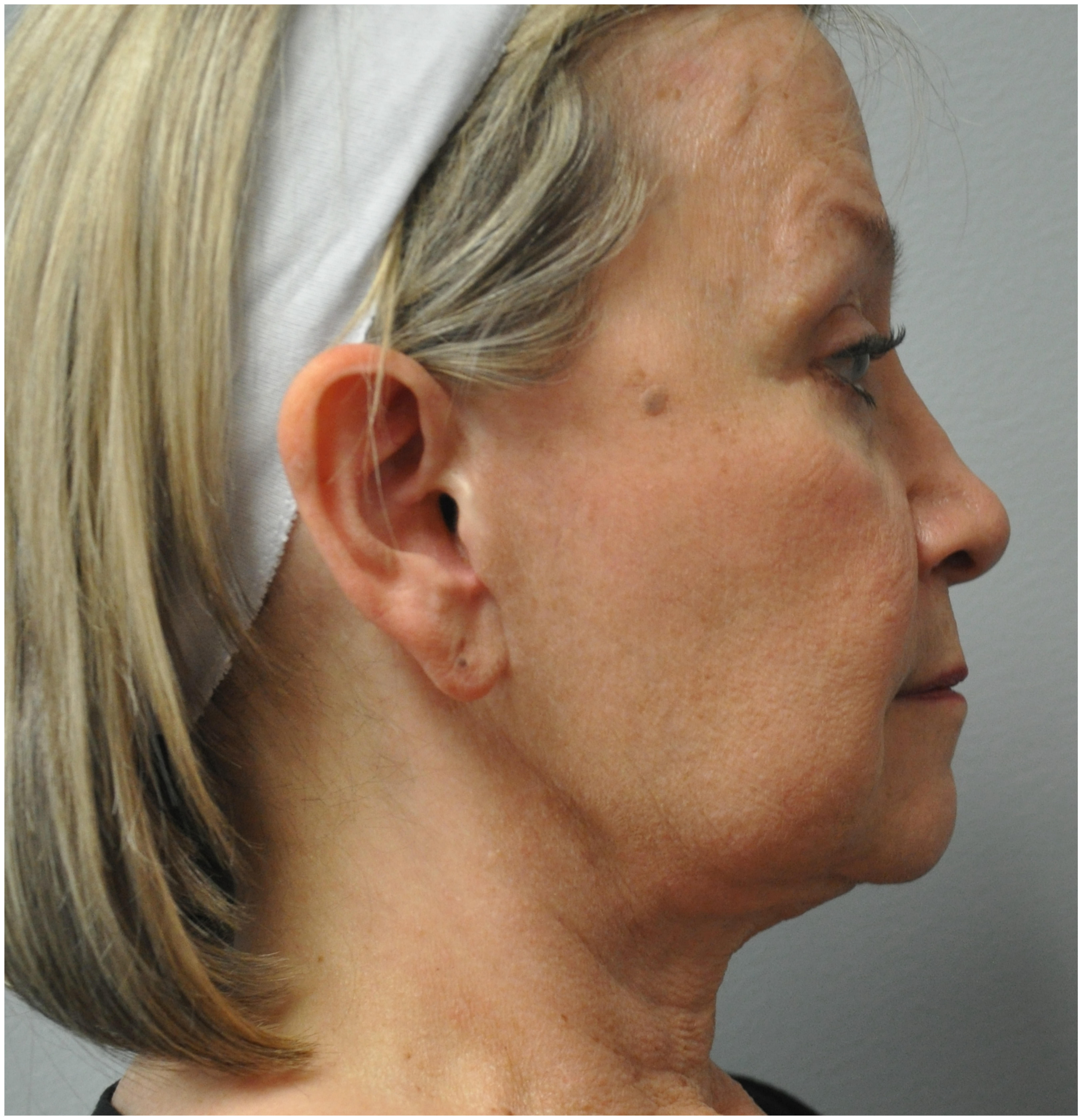 Facelift Before and After | Little Lipo