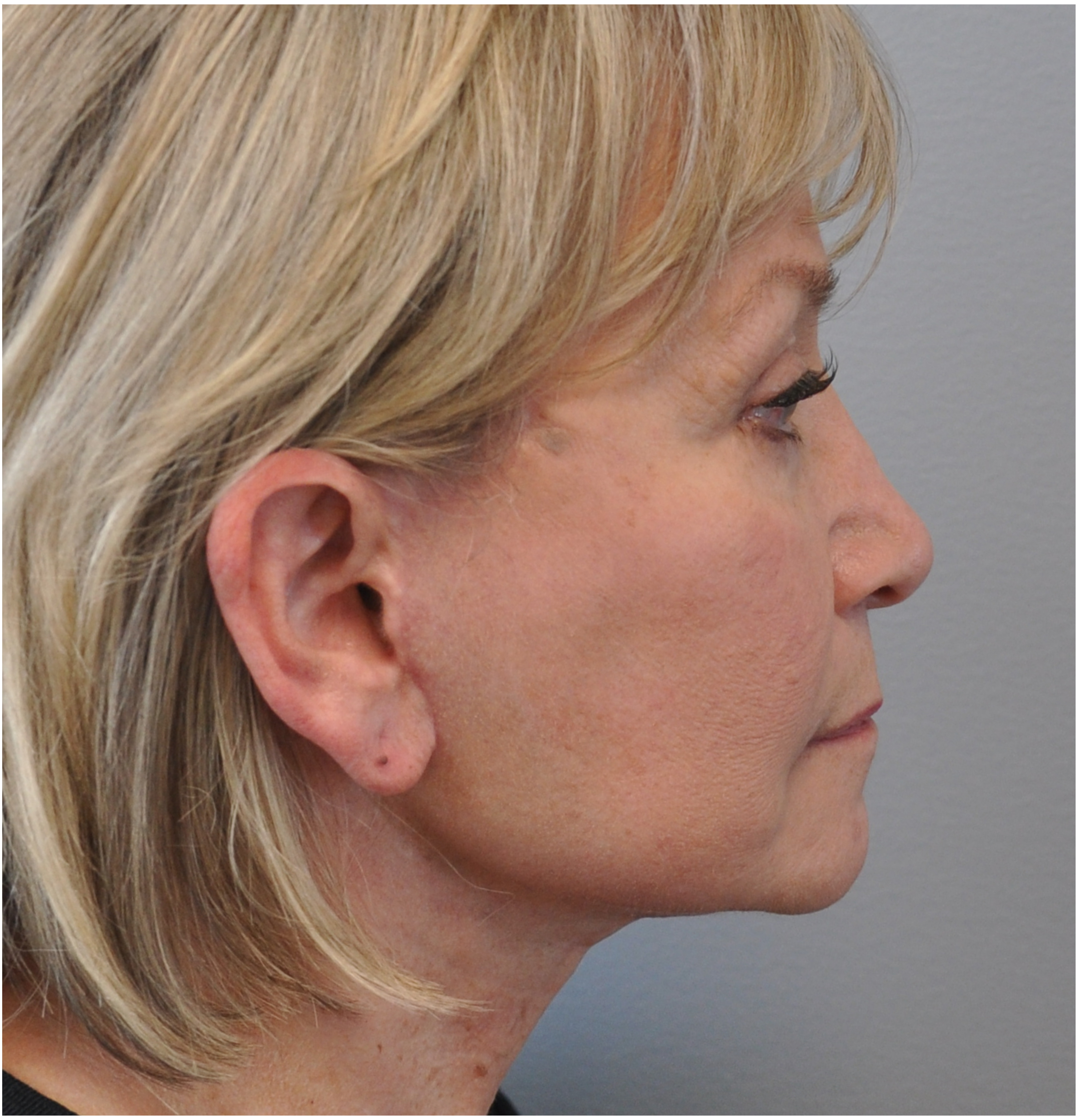 Facelift Before and After | Little Lipo