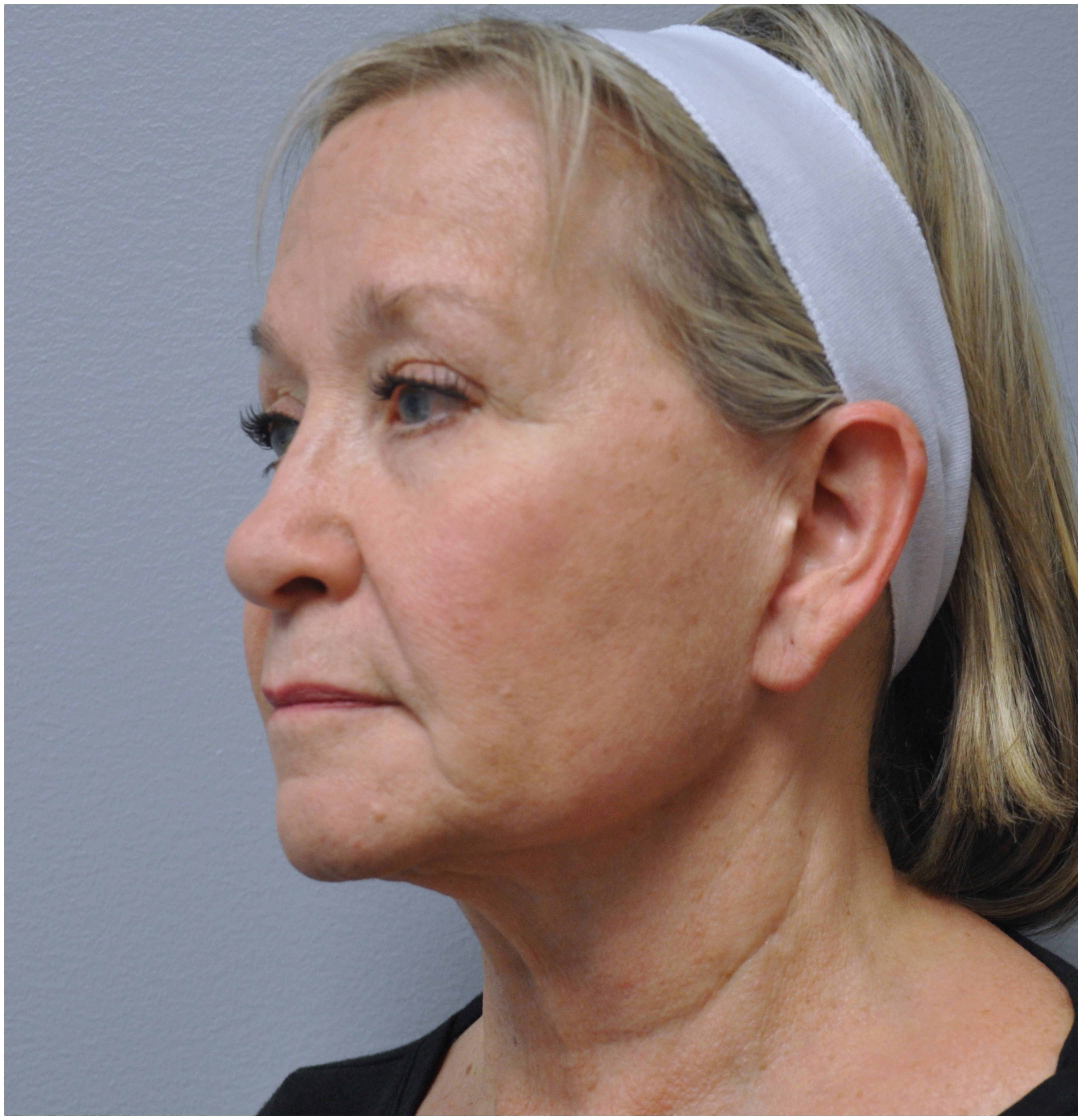 Facelift Before and After | Little Lipo