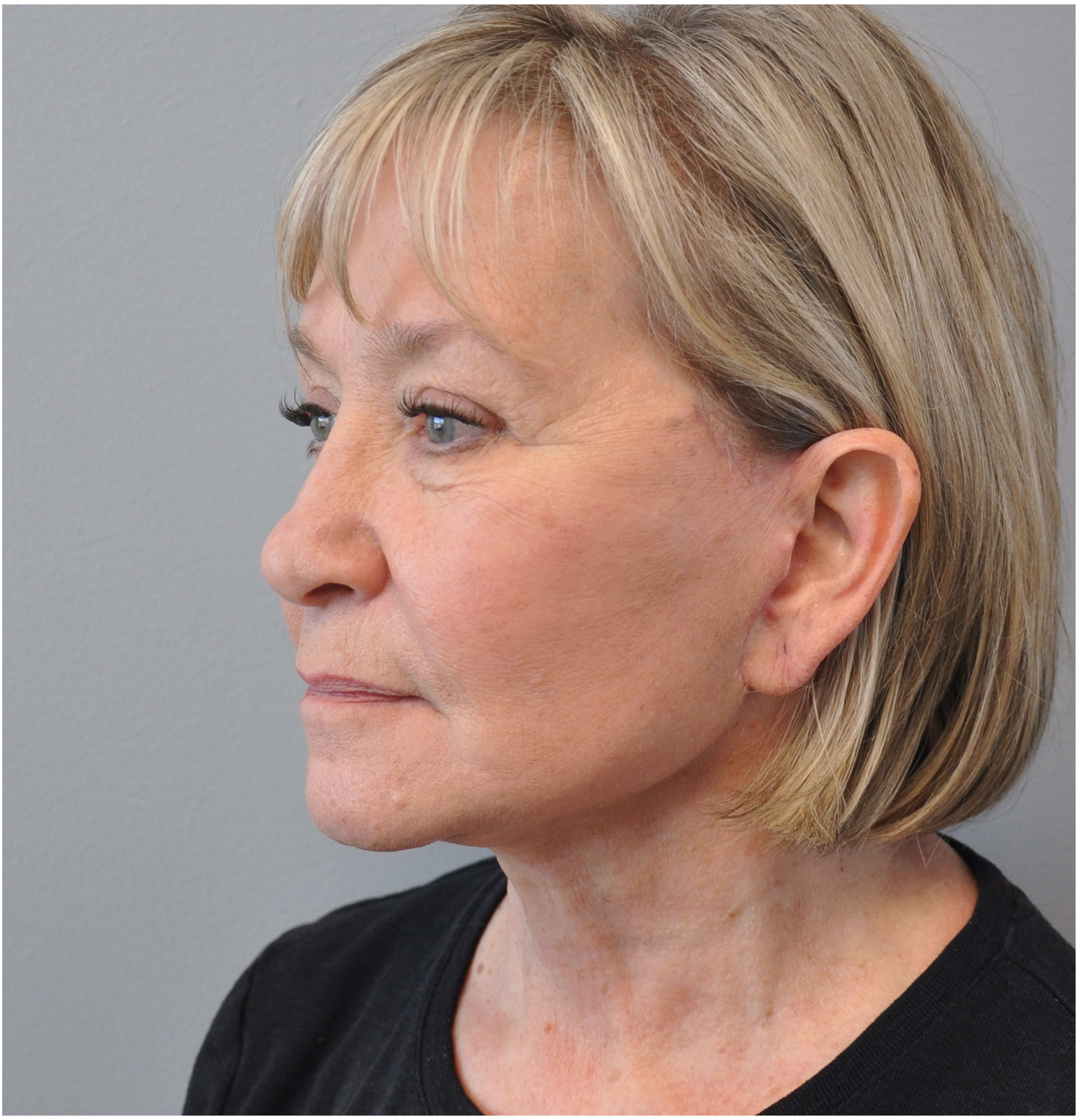 Facelift Before and After | Little Lipo