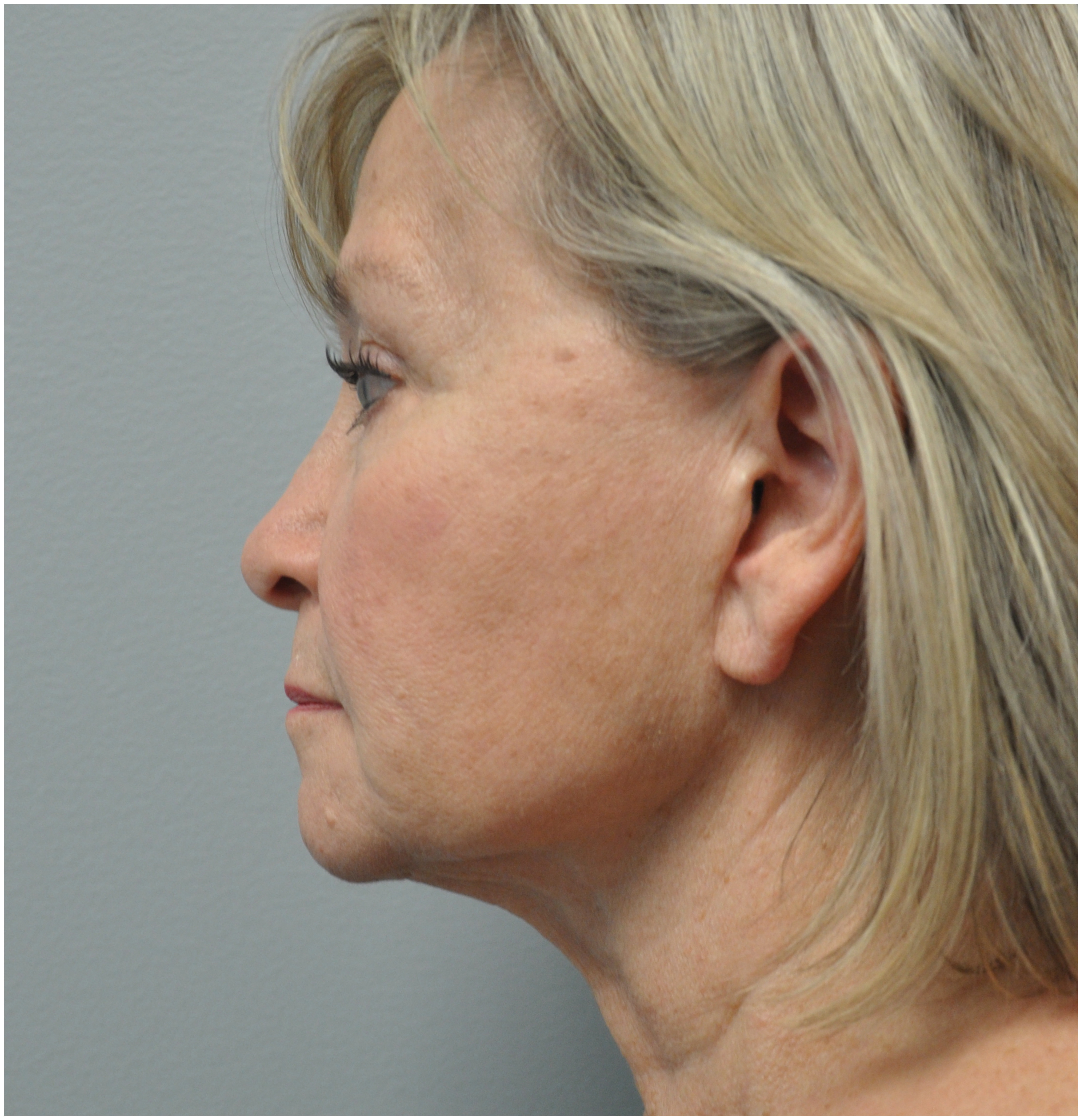 Facelift Before and After | Little Lipo