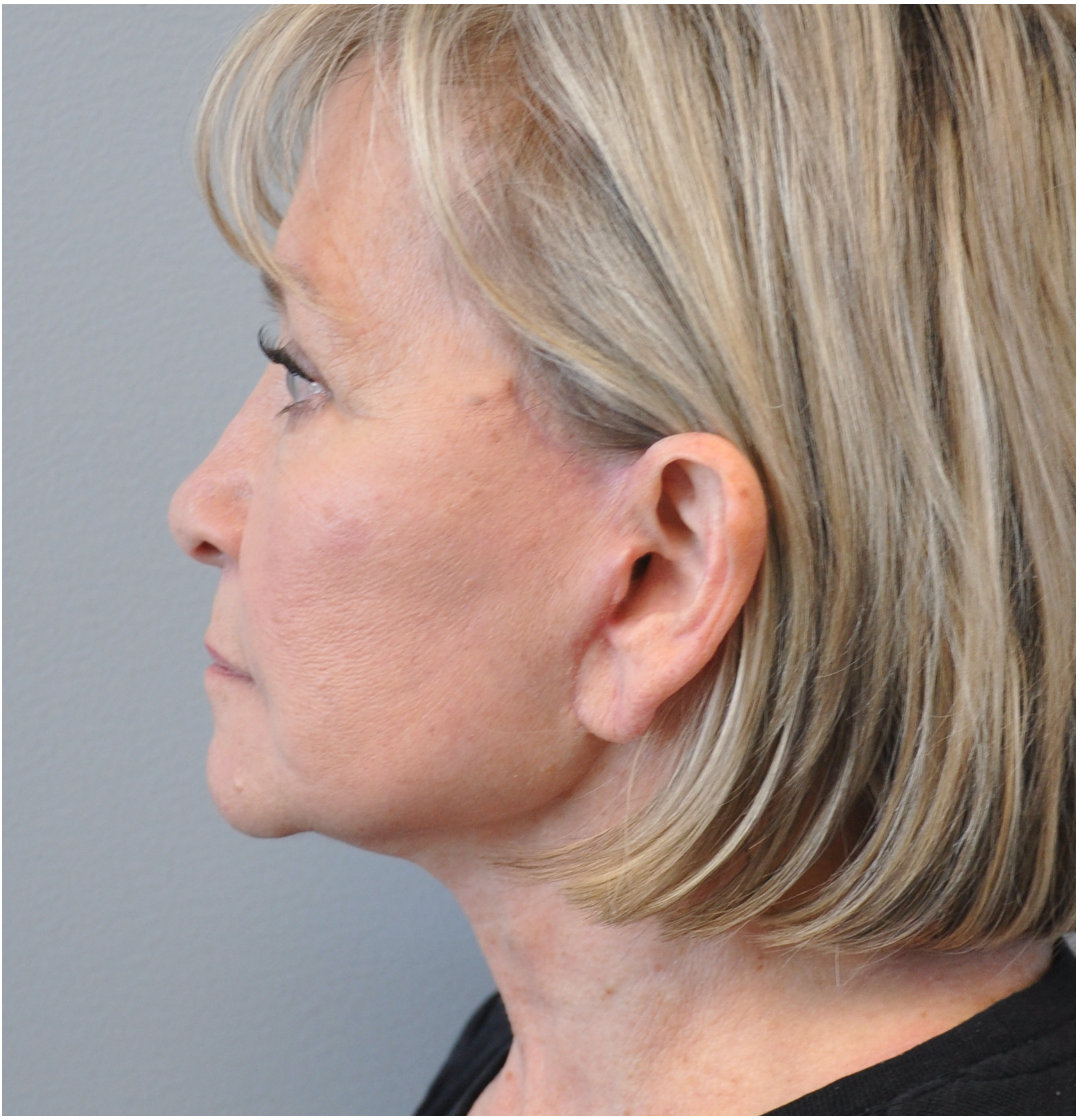 Facelift Before and After | Little Lipo