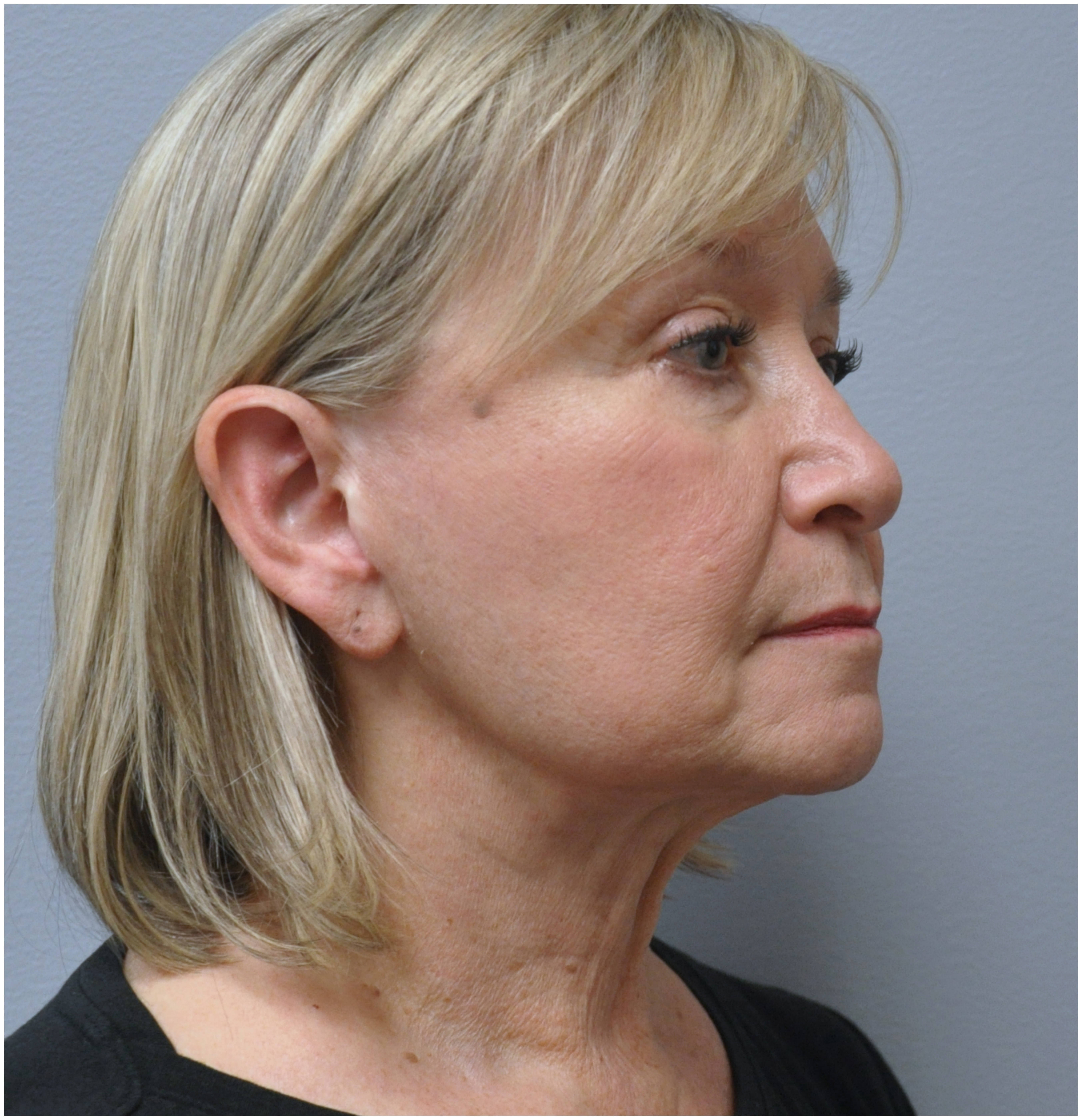 Facelift Before and After | Little Lipo