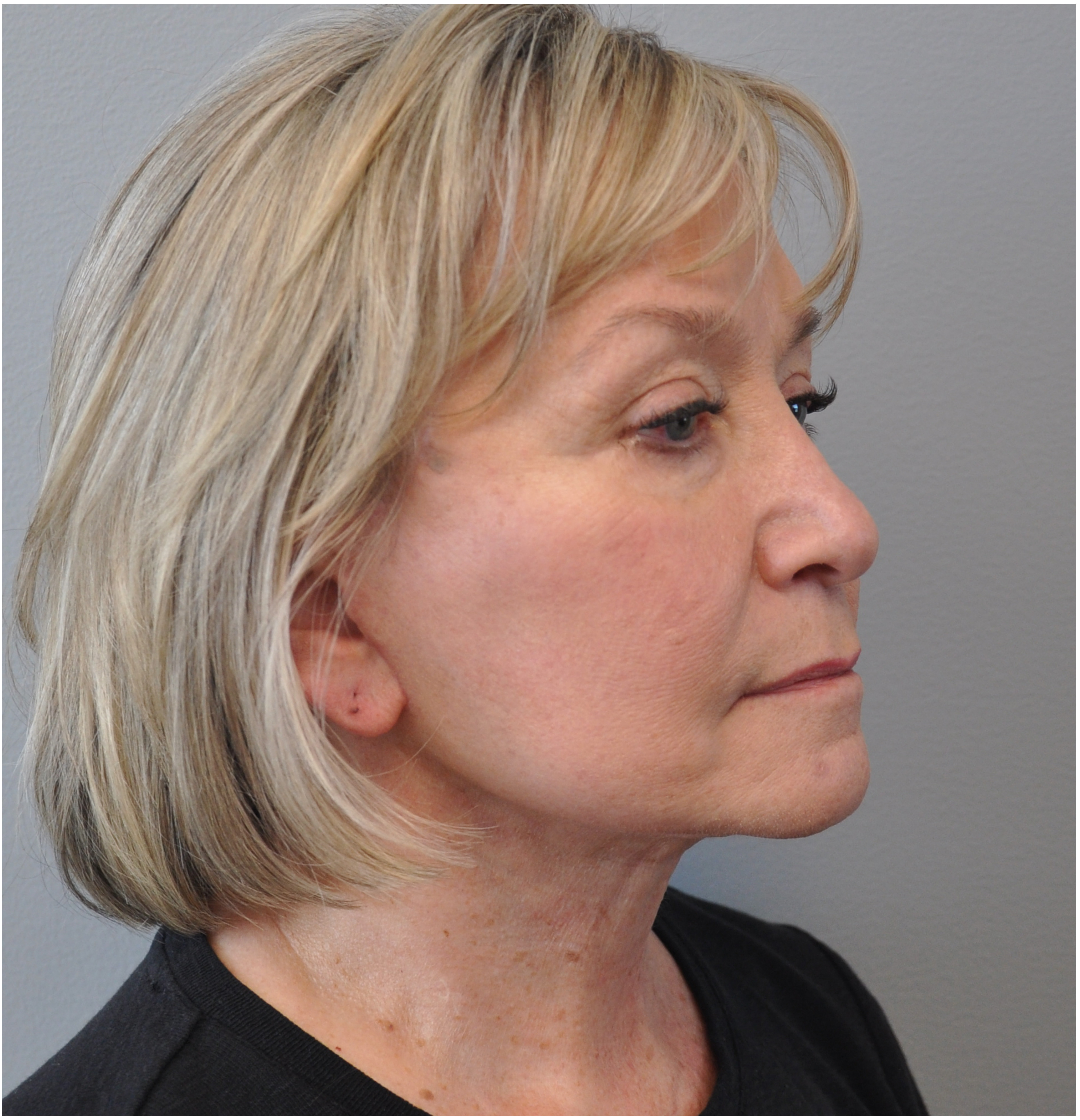 Facelift Before and After | Little Lipo