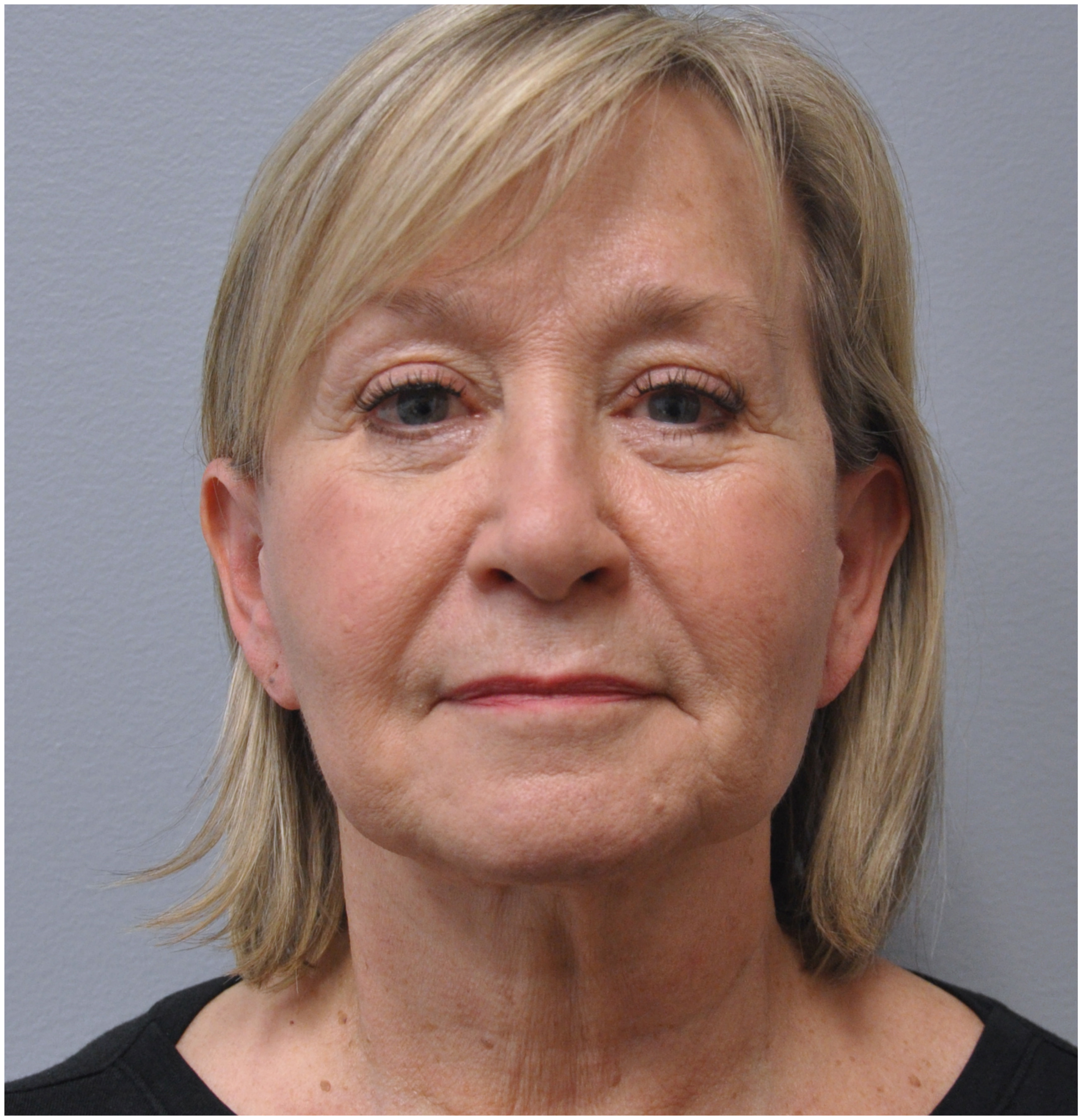 Facelift Before and After | Little Lipo