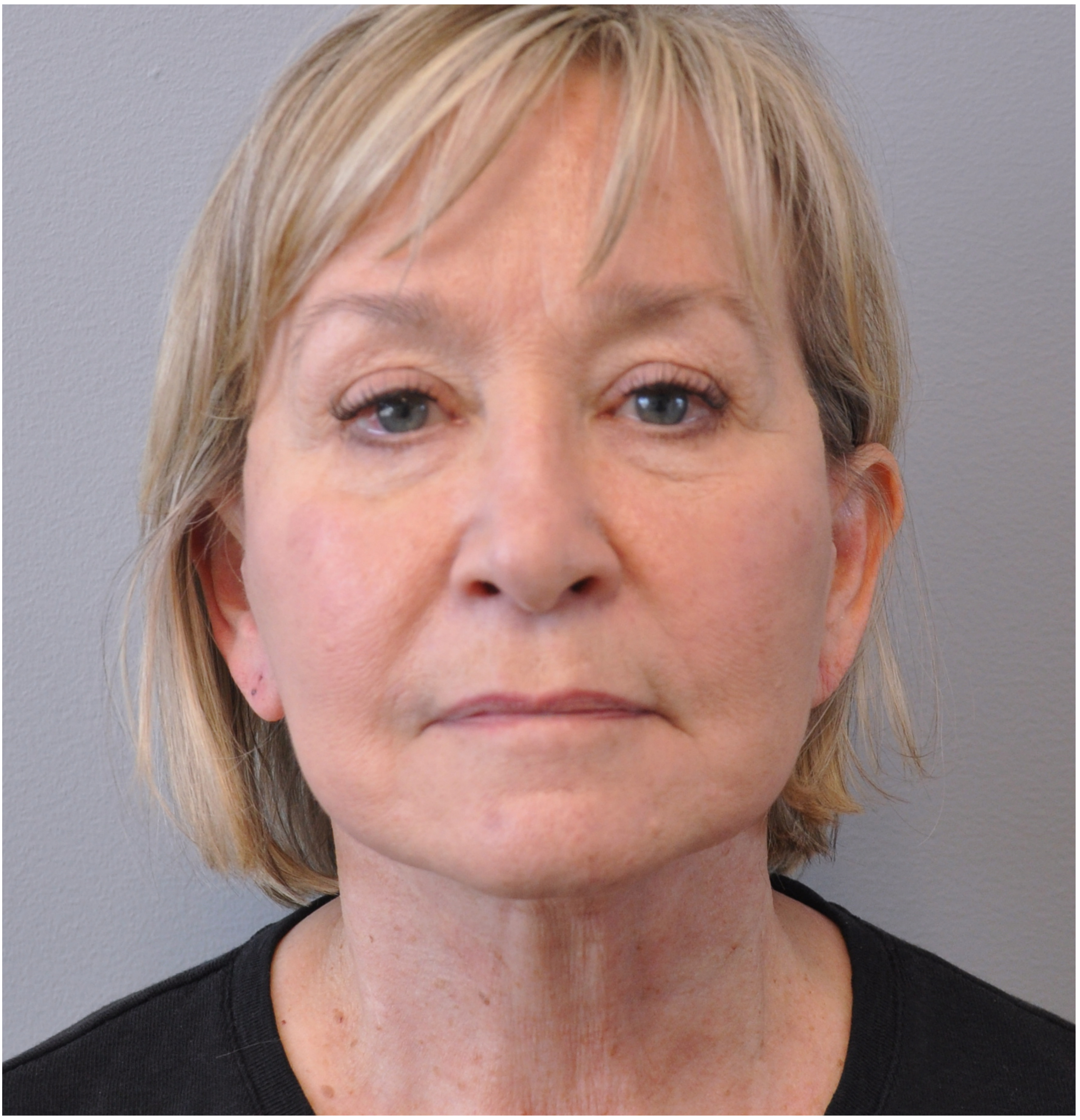 Facelift Before and After | Little Lipo