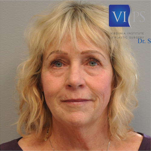 Facelift Before and After | Little Lipo