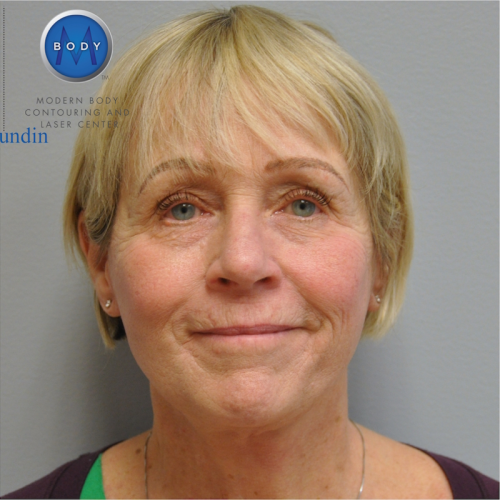 Facelift Before and After | Little Lipo