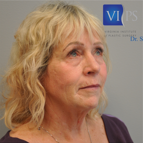 Facelift Before and After | Little Lipo