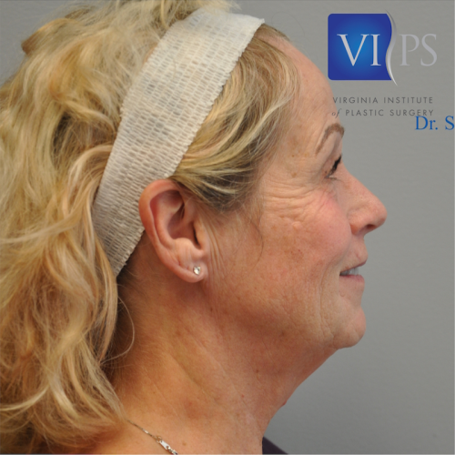 Facelift Before and After | Little Lipo