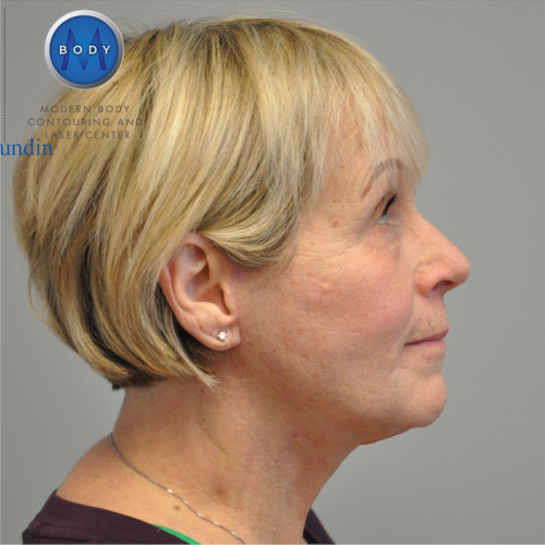 Facelift Before and After | Little Lipo