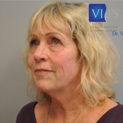 Facelift Before and After | Little Lipo