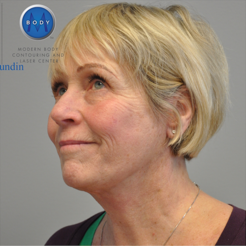 Facelift Before and After | Little Lipo