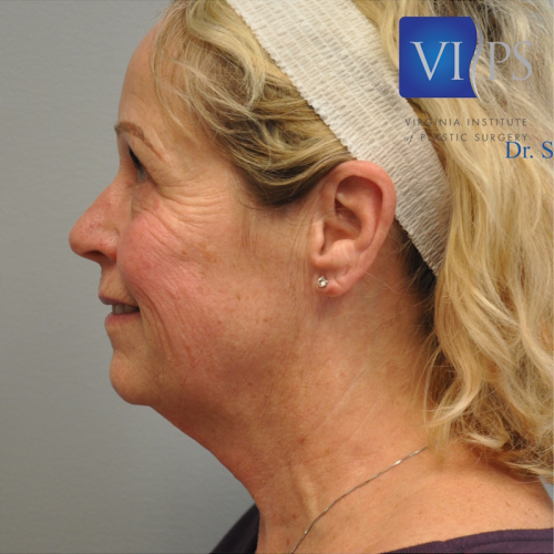 Facelift Before and After | Little Lipo