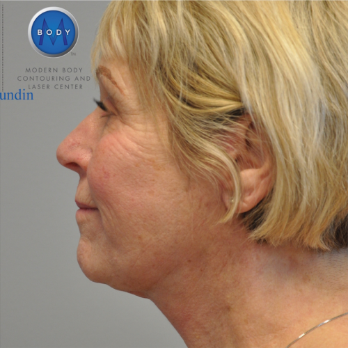 Facelift Before and After | Little Lipo