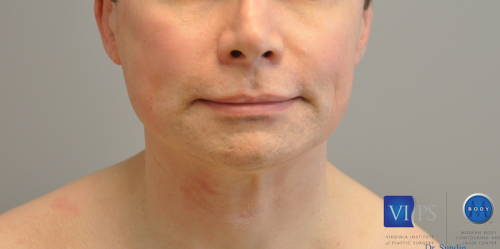 Facelift Before and After | Little Lipo