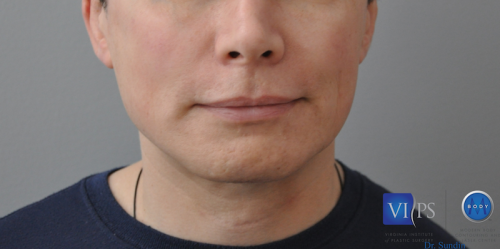 Facelift Before and After | Little Lipo