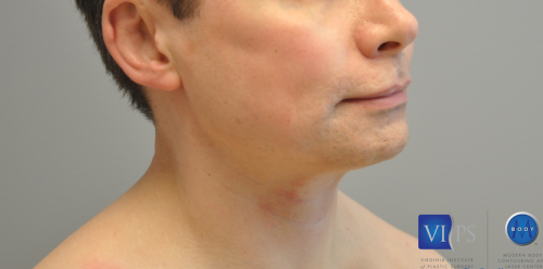 Facelift Before and After | Little Lipo