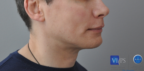 Facelift Before and After | Little Lipo