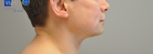 Facelift Before and After | Little Lipo