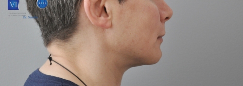 Facelift Before and After | Little Lipo