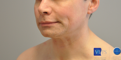 Facelift Before and After | Little Lipo