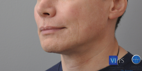 Facelift Before and After | Little Lipo