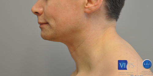 Facelift Before and After | Little Lipo