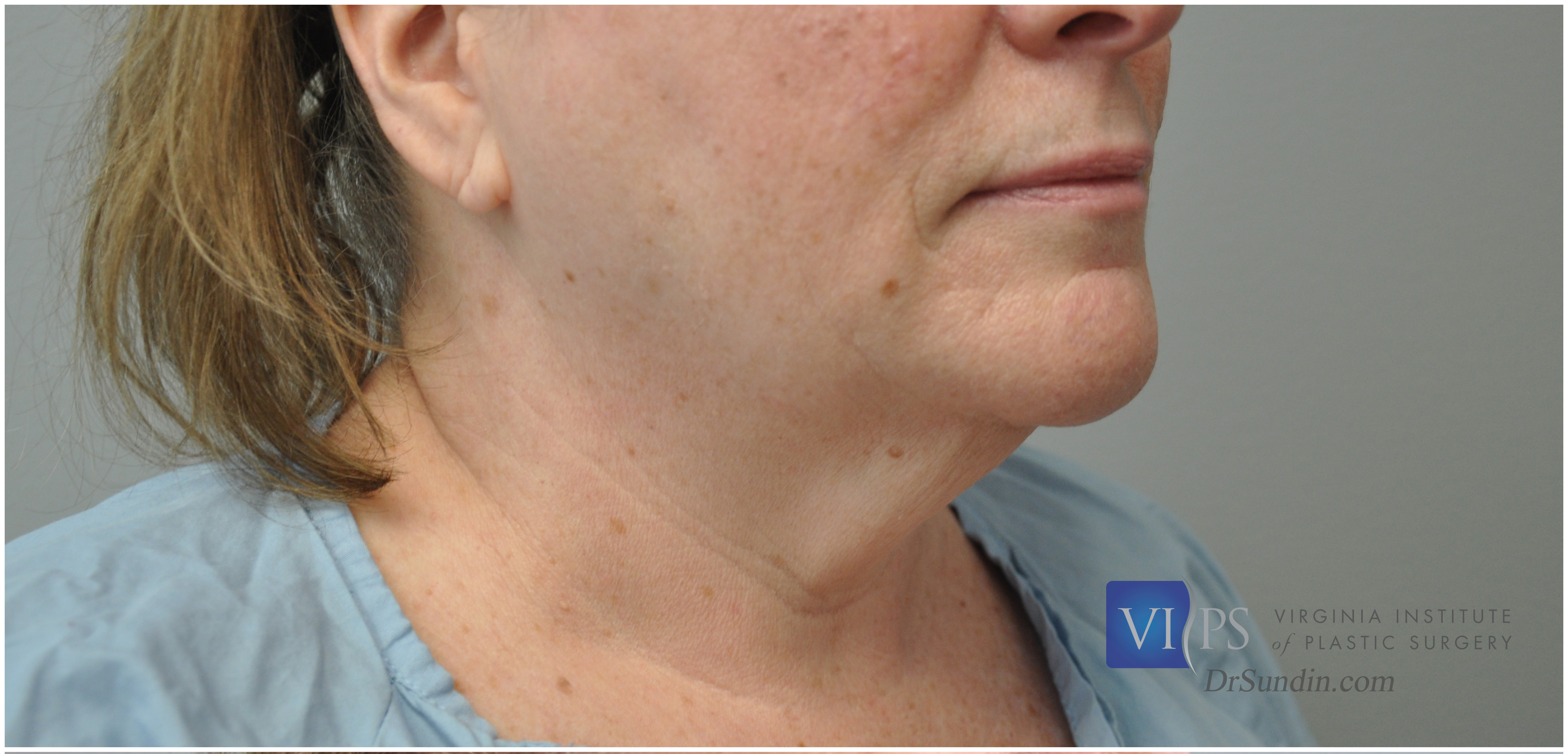 Facelift Before and After | Little Lipo