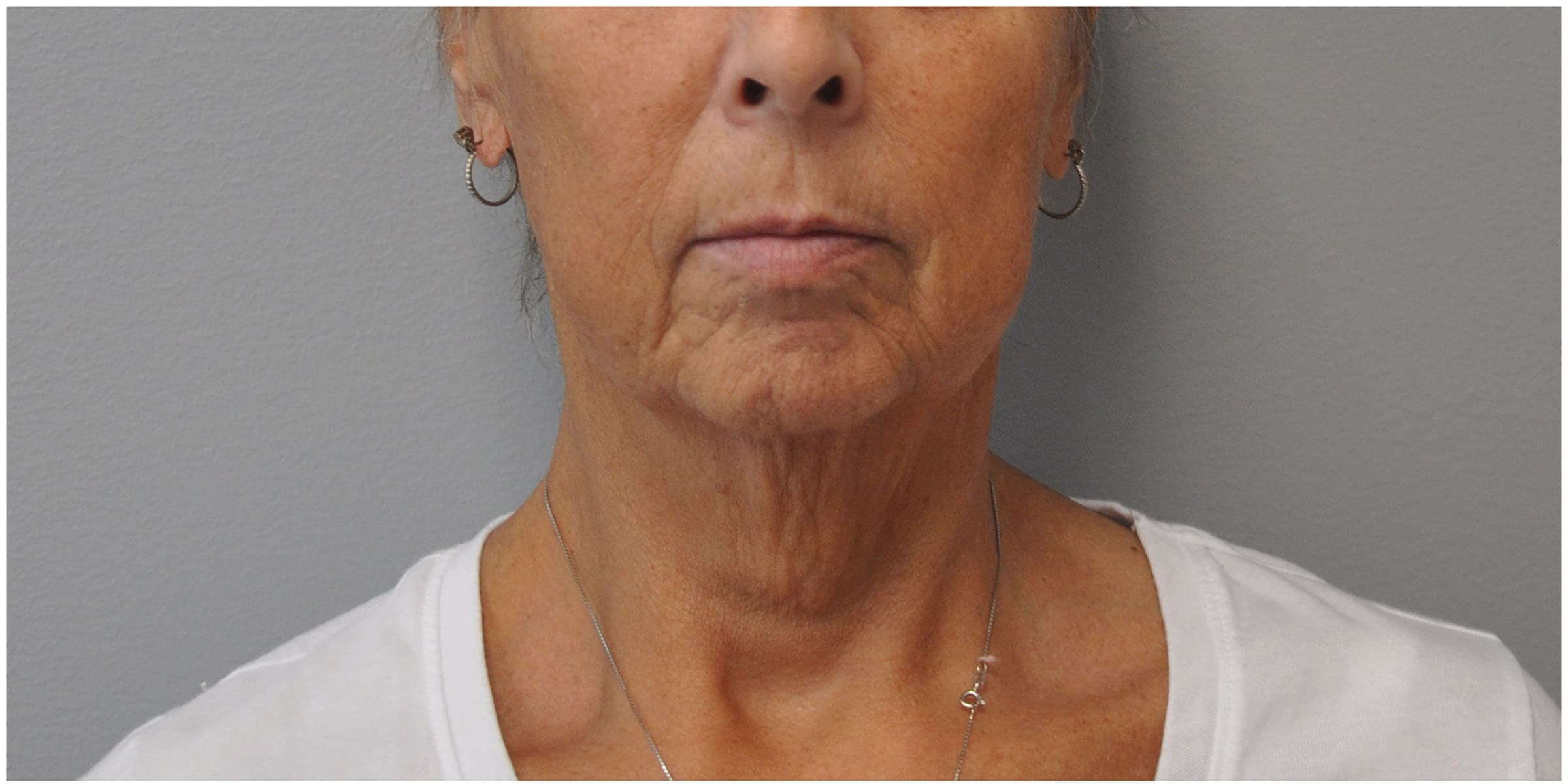Facelift Before and After | Little Lipo