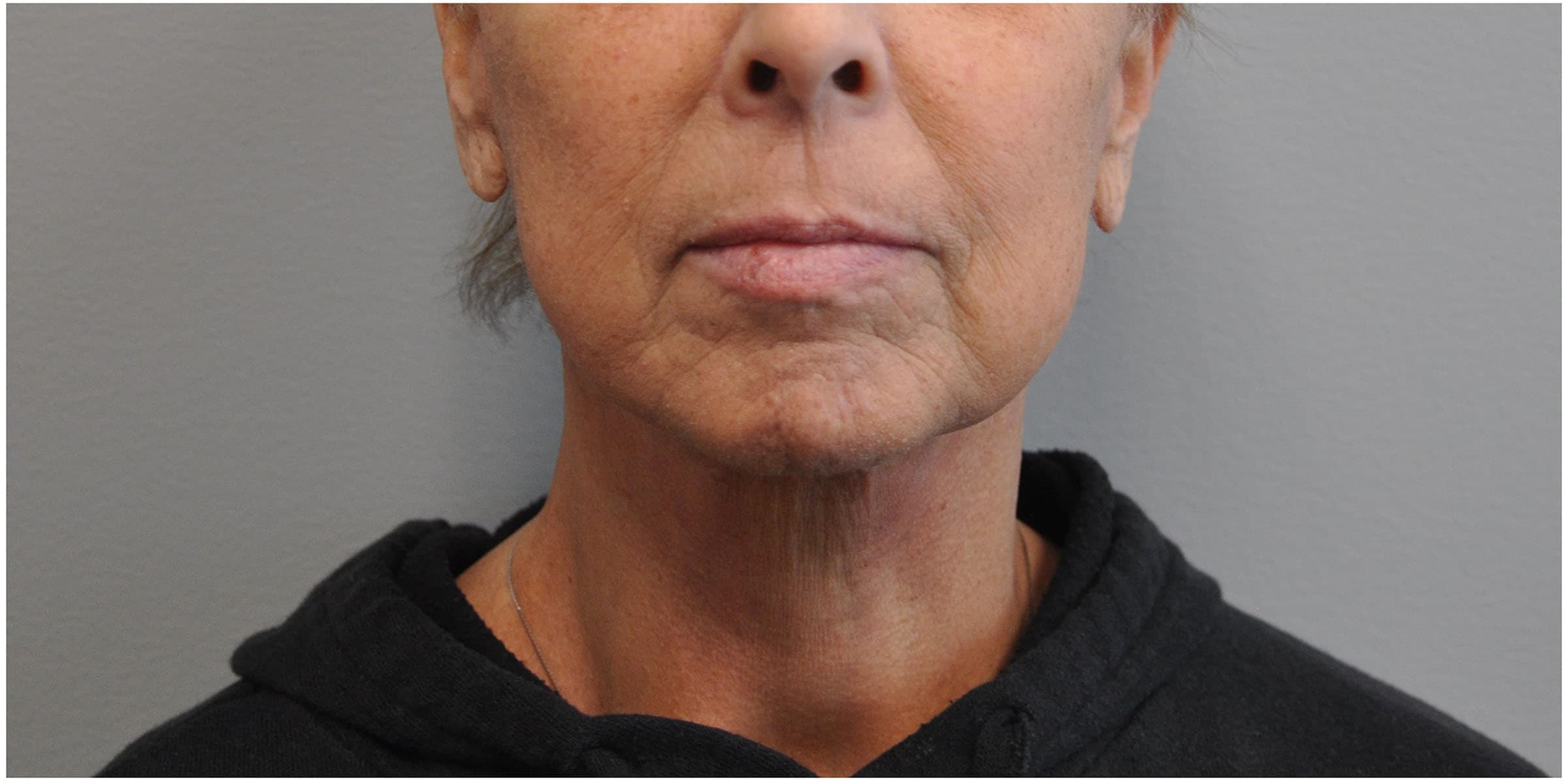 Facelift Before and After | Little Lipo