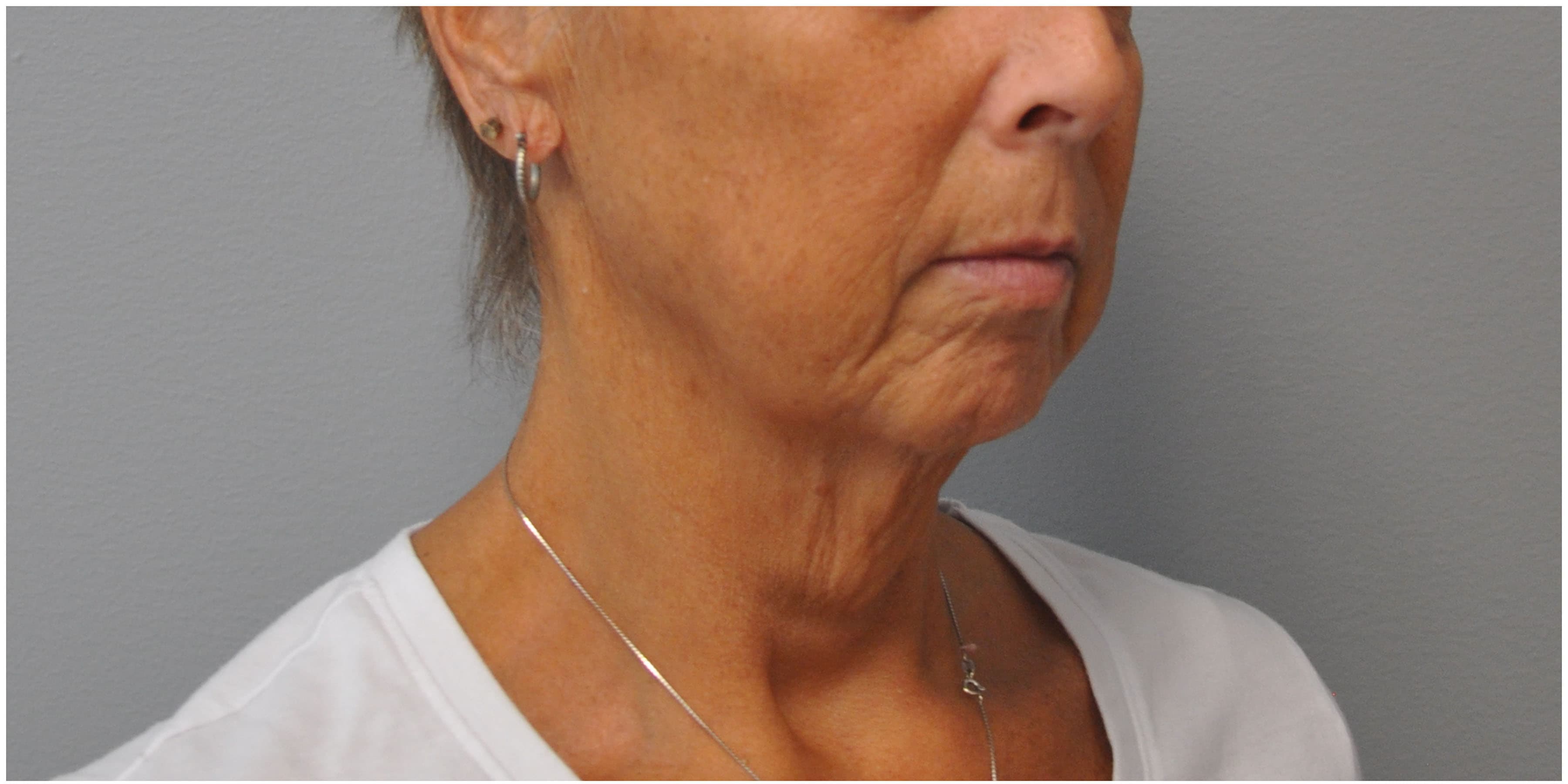 Facelift Before and After | Little Lipo