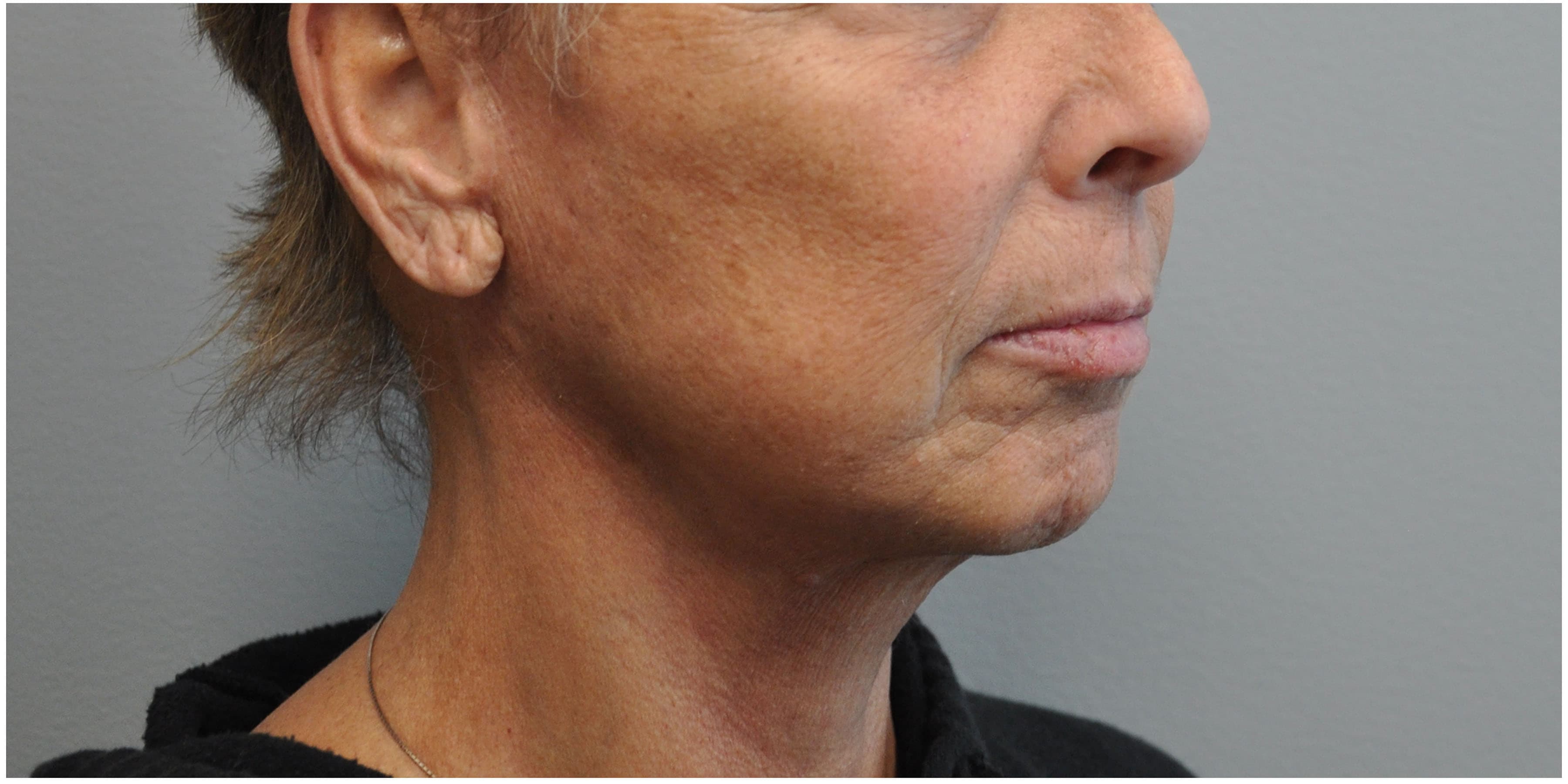 Facelift Before and After | Little Lipo