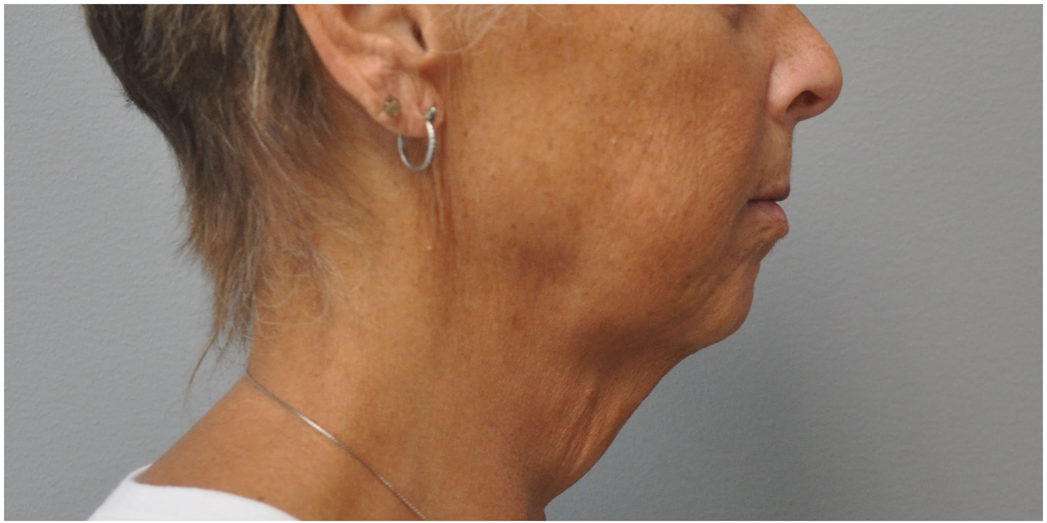 Facelift Before and After | Little Lipo