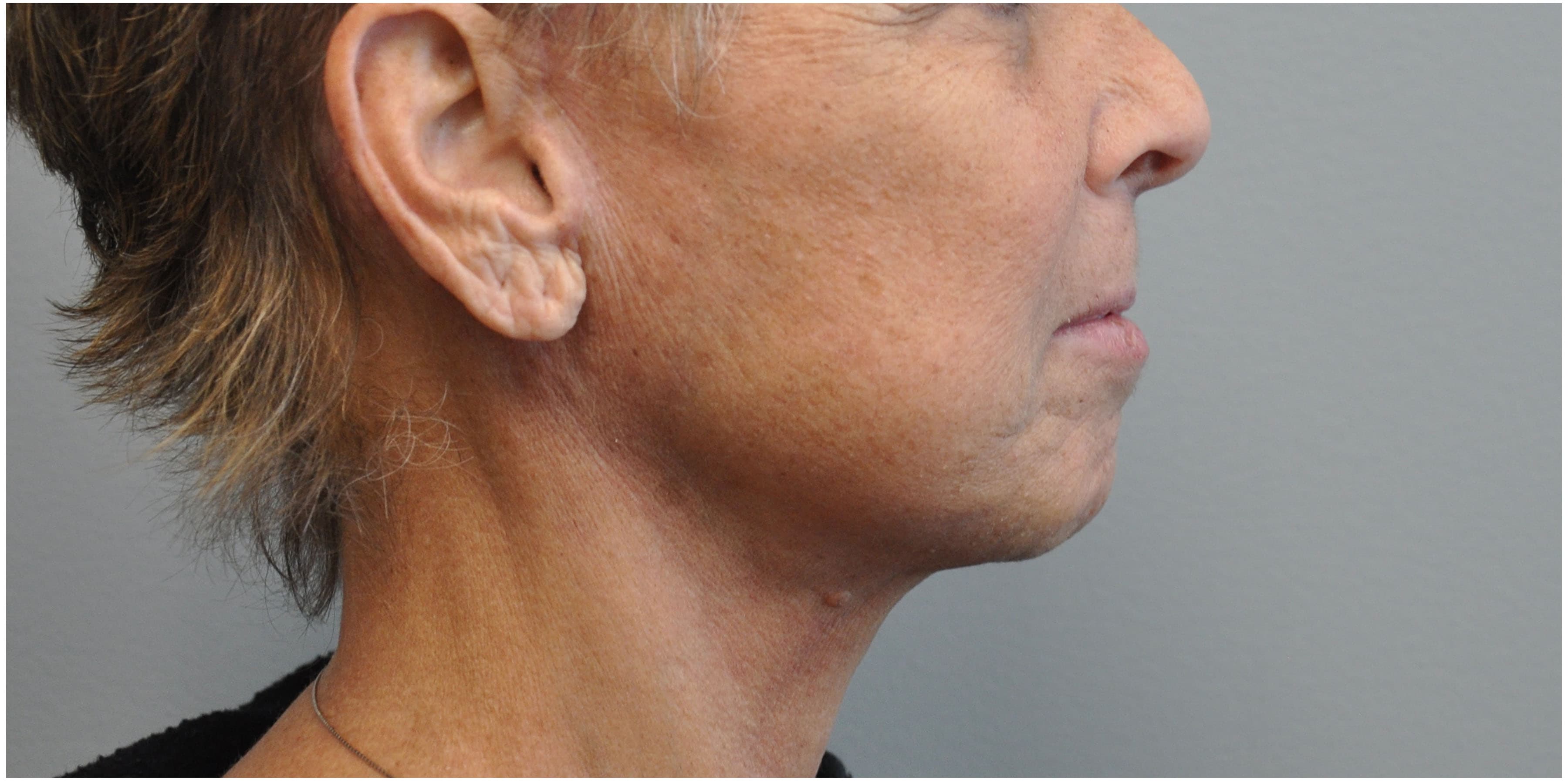 Facelift Before and After | Little Lipo