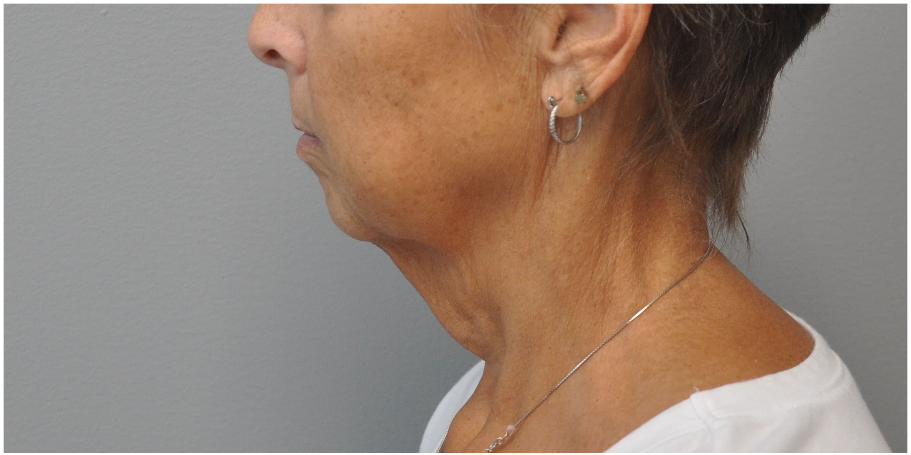 Facelift Before and After | Little Lipo